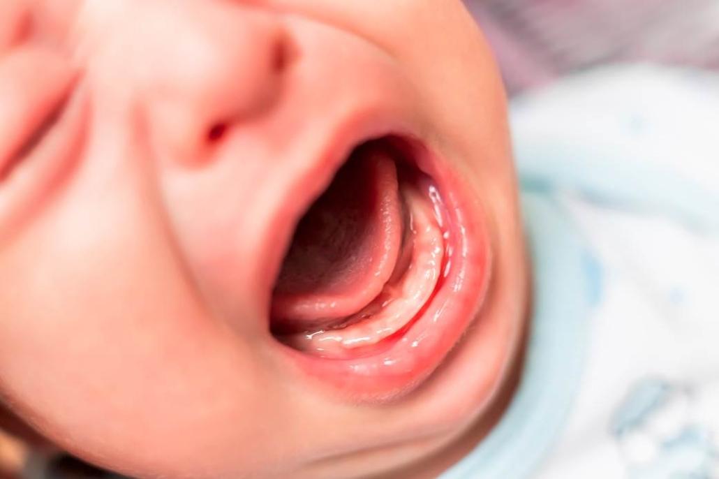 Causas e como aliviar a gengiva inchada no bebê